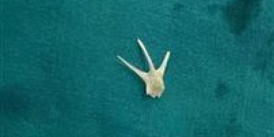 فريق طبي بسوهاج الجامعي ينجح في استخراج شوكة سمكة من القصبة الهوائية لطفل