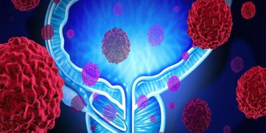 دراسة بريطانية: اختبار ذكاء اصطناعي جديد يمنح أملا جديدا لمرضى سرطان البروستاتا