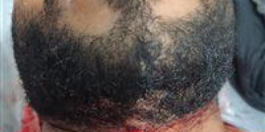 القبض على عاطل بالفيوم تعد على عامل بمحل كشري وأصابة بحرخ ذبحي بالرقبة