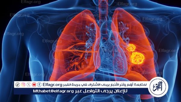 أول مريض في المملكة المتحدة يتلقى لقاحا مبتكرا لسرطان الرئة