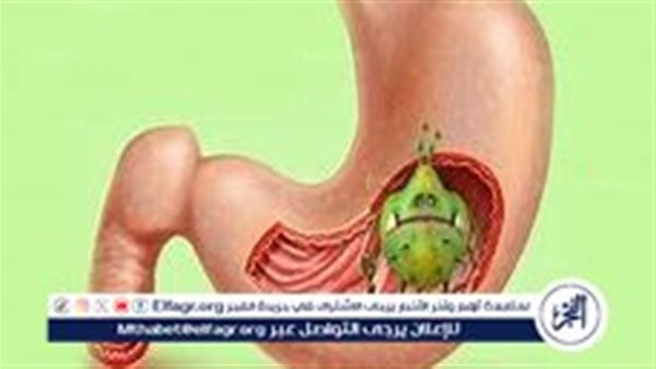 “جرثومة المعدة” الأسباب والأعراض وأثر المشروبات على الإصابة