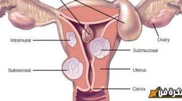 تجربتي المؤلمة والمفيدة مع تليف الرحم: رحلة نحو الفهم والتعافي